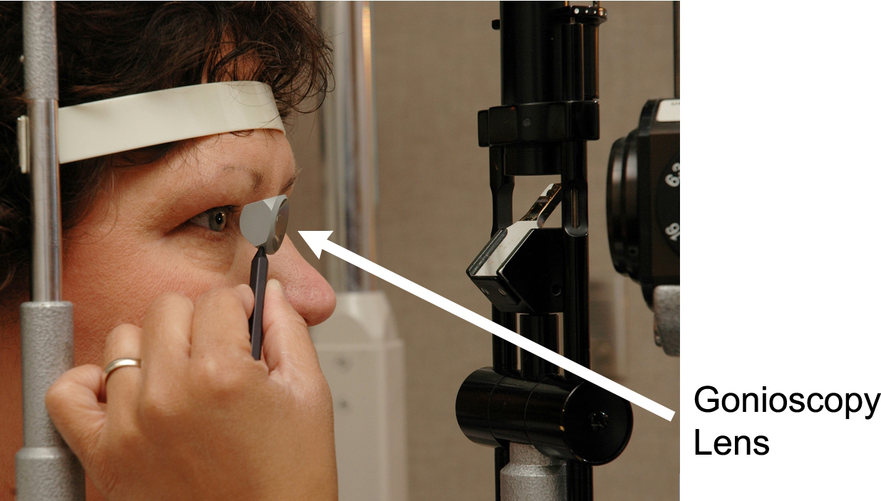 A patient undergoing gonioscopy 